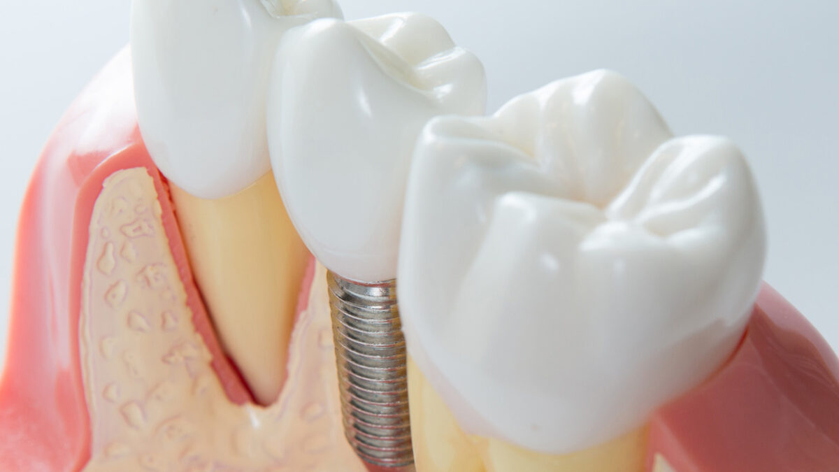 implantologia dentale san giovanni zevio verona